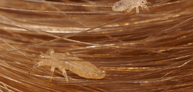 Chấy tóc (Lice)