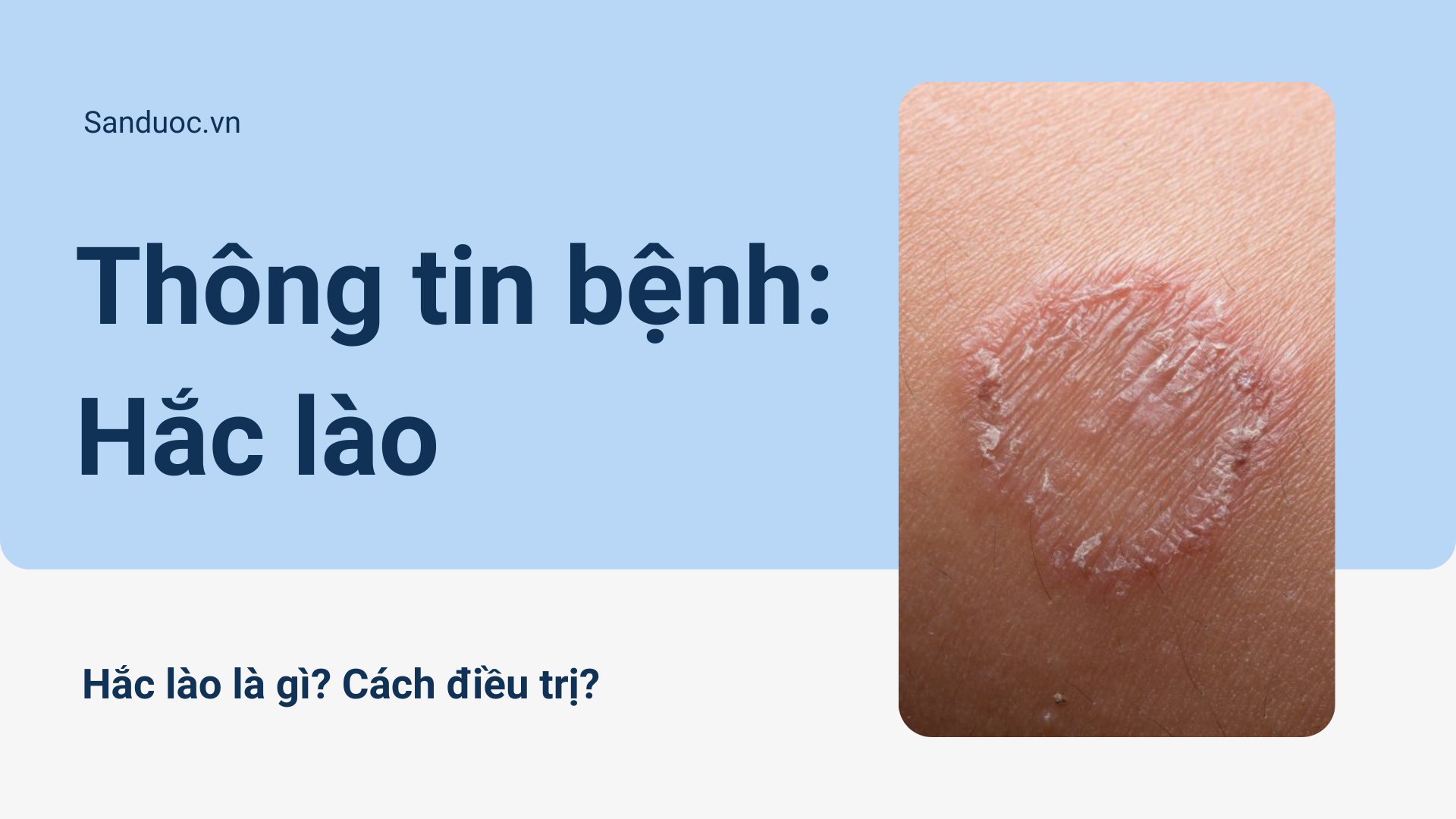 Hắc lào là gì? Cách điều trị Hắc lào?